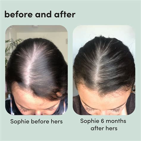 dangers of minoxidil for women.